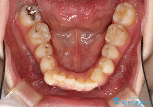 歯のでこぼこ / インビザライン治療の治療前
