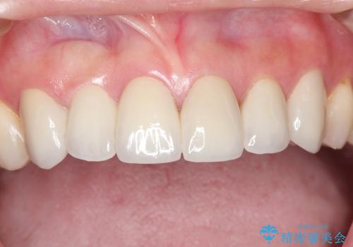 3年経過症例　歯茎の再生でブリッジをきれいに　まるで自分の歯の治療後