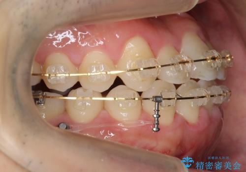 [30代男性 受け口 オペケース] 顎の手術を回避 歯を抜かない矯正の治療中