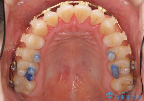 [30代男性 受け口 オペケース] 顎の手術を回避 歯を抜かない矯正の治療中
