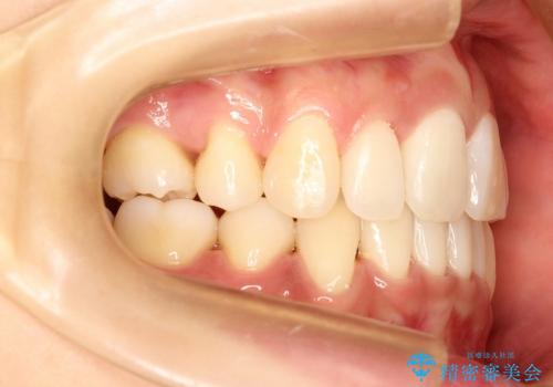 出っ歯と口元の改善の治療後