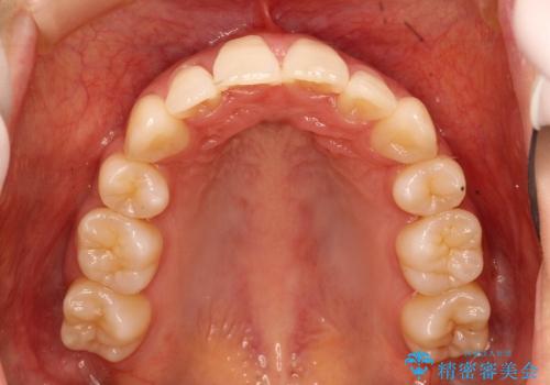 出っ歯と口元の改善の治療後