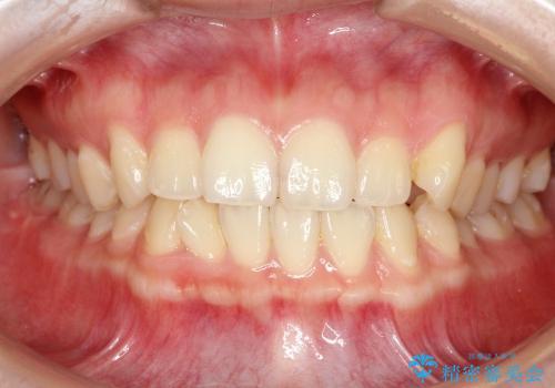 八重歯の部分矯正 / 裏側矯正の治療前
