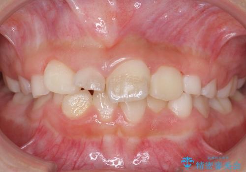 [小児・過剰歯] 埋まっている余分な歯を抜歯の治療前