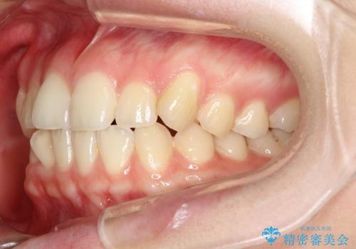 八重歯の部分矯正 / 裏側矯正の治療前