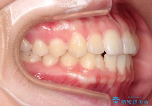 八重歯の部分矯正 / 裏側矯正の治療中