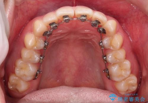 八重歯の部分矯正 / 裏側矯正の治療中