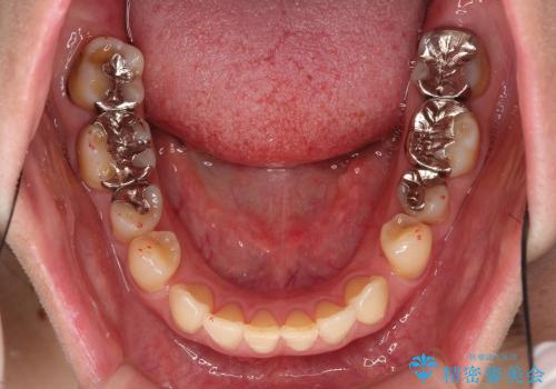 すきっ歯と上唇小帯 / インビザライン治療の治療前