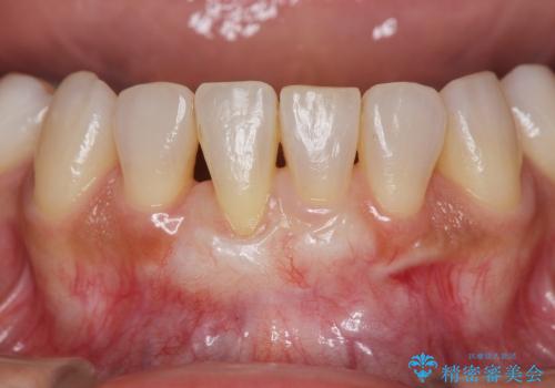 [歯ぐきの再生] 矯正治療中に起きた歯肉退縮に対する歯肉移植の治療後