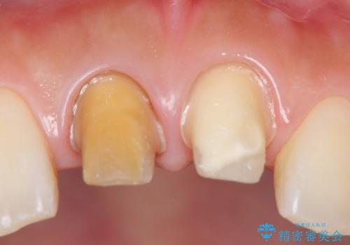 [顕微鏡治療]  前歯部精密審美オールセラミック治療の治療中