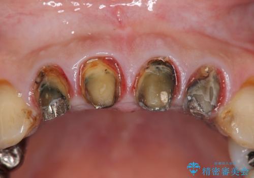 [前歯部審美治療] 保険適応クラウンのジルコニアクラウンへのやりかえの治療前
