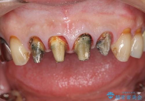 [前歯部審美治療] 保険適応クラウンのジルコニアクラウンへのやりかえの治療前