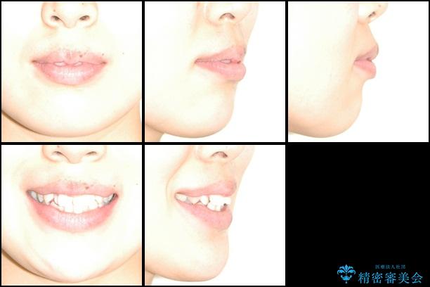 でこぼこと出っ歯　口元改善の抜歯矯正　審美装置の治療前（顔貌）