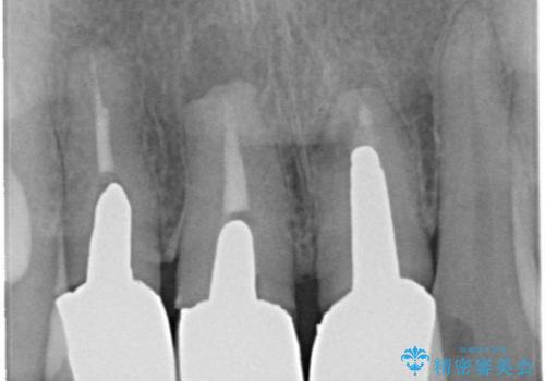 被せ物と歯ぐきの間の黒ずみ / セラミックのやり替えの治療前