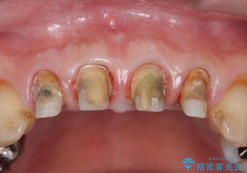 [前歯部審美治療] 保険適応クラウンのジルコニアクラウンへのやりかえの治療中
