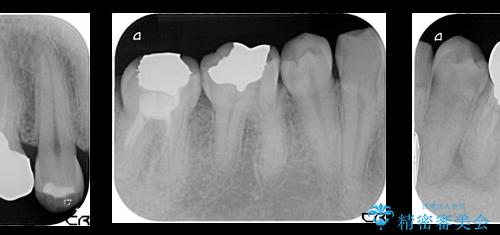 セラミック治療と再矯正 / 出っ歯とすきっ歯を治したいの治療前
