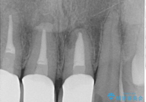 被せ物と歯ぐきの間の黒ずみ / セラミックのやり替えの治療後