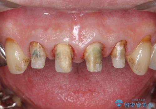 [前歯部審美治療] 保険適応クラウンのジルコニアクラウンへのやりかえの治療中