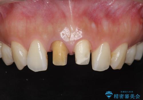 [顕微鏡治療]  前歯部精密審美オールセラミック治療の治療中