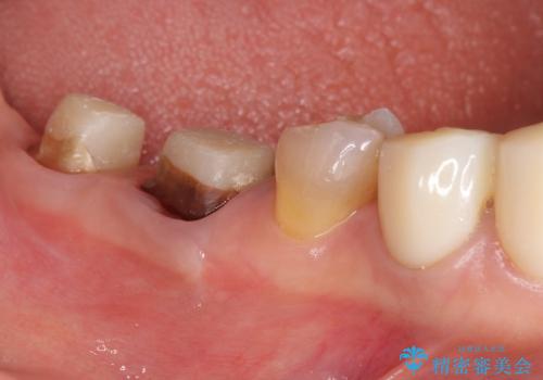 [深い虫歯]  歯周外科を用いたオールセラミック治療の治療中