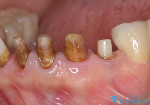[深い虫歯]  歯の挺出処置を行ったオールセラミック治療の治療中
