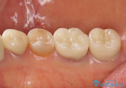[深い虫歯]  歯周外科を用いたオールセラミック治療の治療後