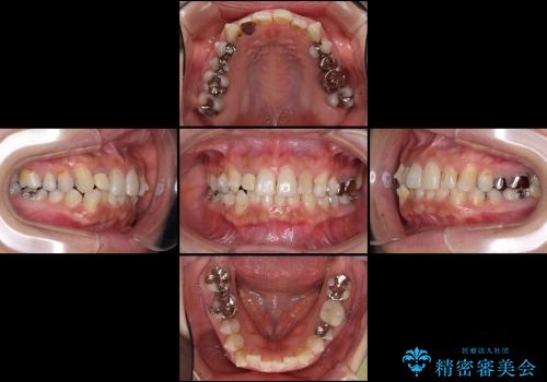 総合歯科診療 ～ インビザラインによる矯正治療と前歯の審美治療の治療中