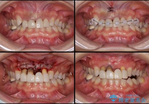 歯肉の腫れた前歯　部分矯正と歯周外科後の審美治療の治療中