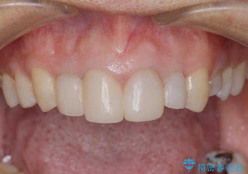 [前歯部審美治療] 仮歯からオールセラミッククラウンへの治療前