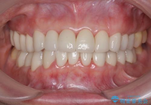 [酸蝕歯] オールセラミッククラウンを用いた全顎治療の症例 治療後