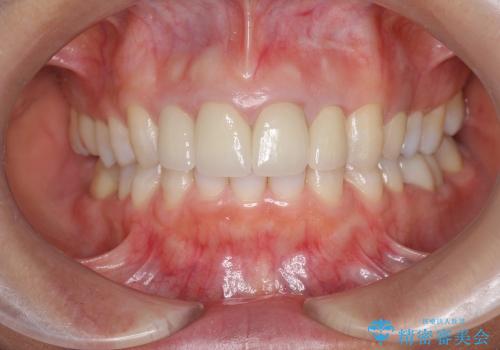[前歯部審美治療] 仮歯からオールセラミッククラウンへの治療後