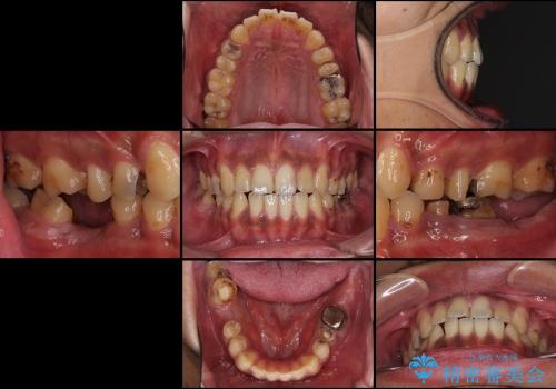 輝かしい口元を　オールセラミッククラウンによる全顎虫歯治療の治療前