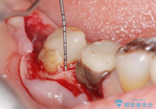 [深い虫歯]  歯周外科を用いたオールセラミック治療の治療中