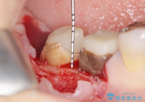 [深い虫歯]  歯周外科を用いたオールセラミック治療