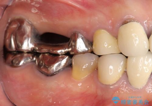 [深い虫歯]  歯周外科を用いたオールセラミック治療の症例 治療前
