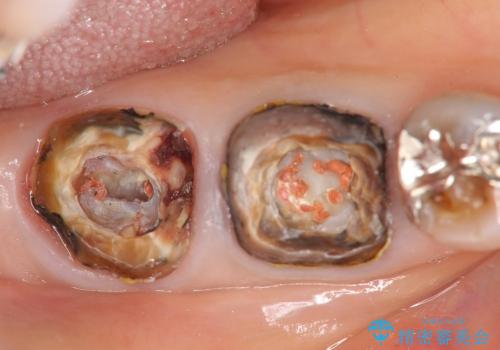 [深い虫歯]  歯周外科を用いたオールセラミック治療の治療前