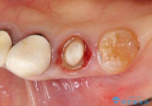 [深い虫歯]  歯の挺出処置を行ったオールセラミック治療の治療前