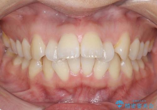20代女性　出っ歯　天然歯を残す治療の症例 治療前