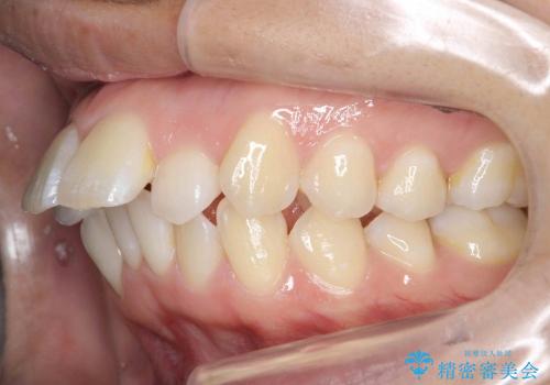 20代女性　出っ歯　天然歯を残す治療の治療前