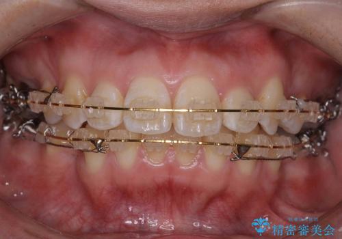 20代女性　出っ歯　天然歯を残す治療の治療中