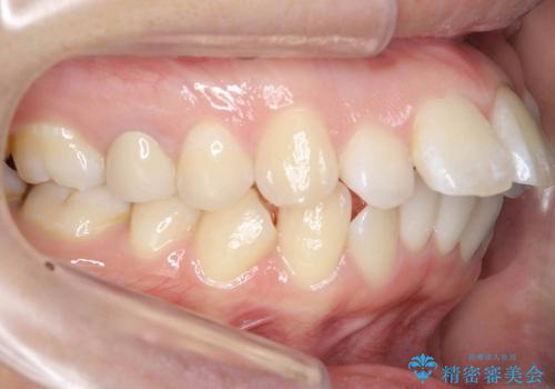 20代女性　出っ歯　天然歯を残す治療の治療前