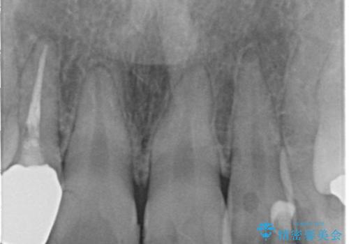 総合歯科診療 ～ インビザラインによる矯正治療と前歯の審美治療の治療前