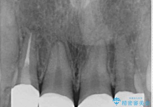総合歯科診療 ～ インビザラインによる矯正治療と前歯の審美治療の治療後