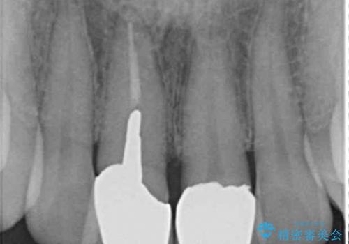 金属の縁が見える　前歯のオールセラミッククラウンの治療前