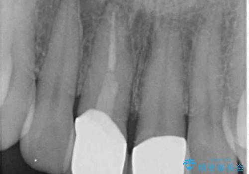 金属の縁が見える　前歯のオールセラミッククラウンの治療後
