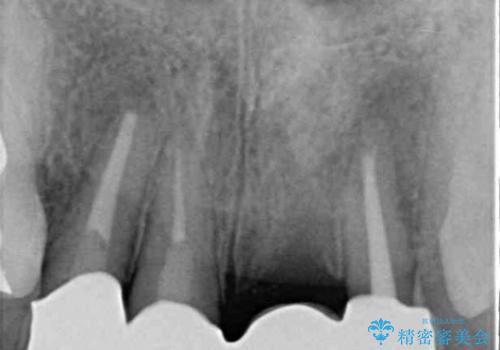 歯肉の腫れた前歯　部分矯正と歯周外科後の審美治療の治療後