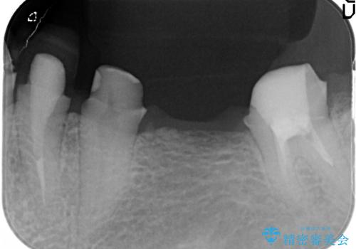 [深い虫歯]  歯の挺出処置を行ったオールセラミック治療の治療中