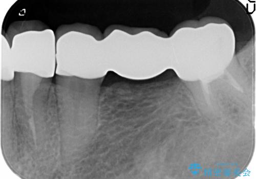 [深い虫歯]  歯の挺出処置を行ったオールセラミック治療の治療後