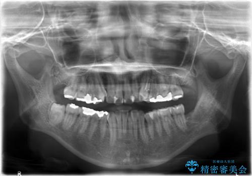 30代女性　八重歯の抜歯矯正の治療前