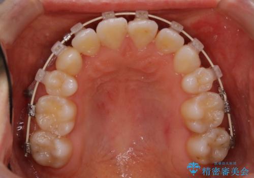 20代女性　歯の数が少ない　軽度の八重歯の治療中